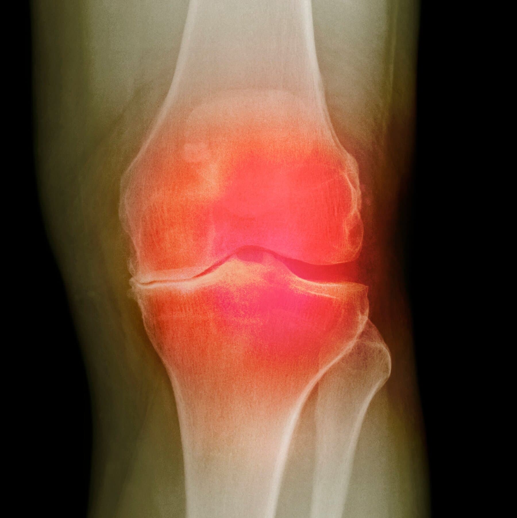 Federal Agency Unveils Three Potential Osteoarthritis Treatments